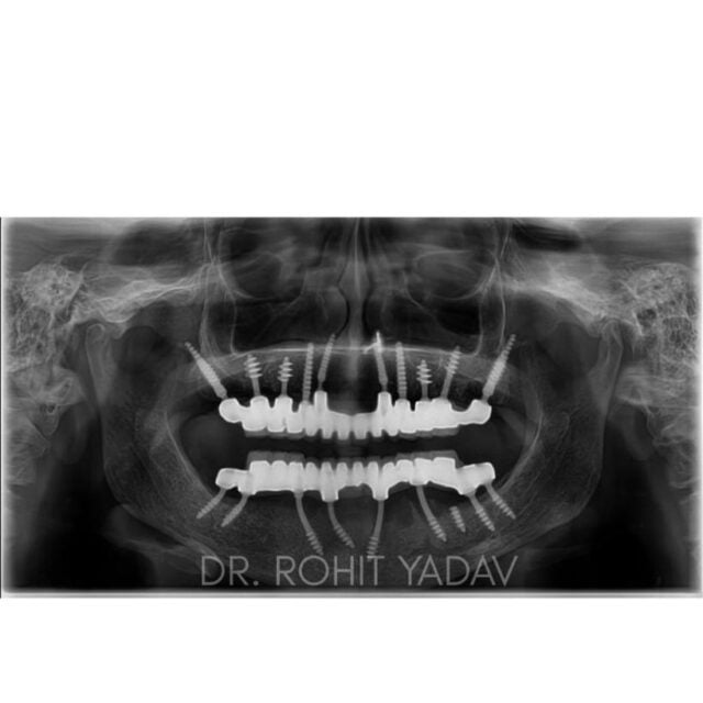 Dr. Rohit Yadav - Patient OPG - Best Implantologist in Noida (16)