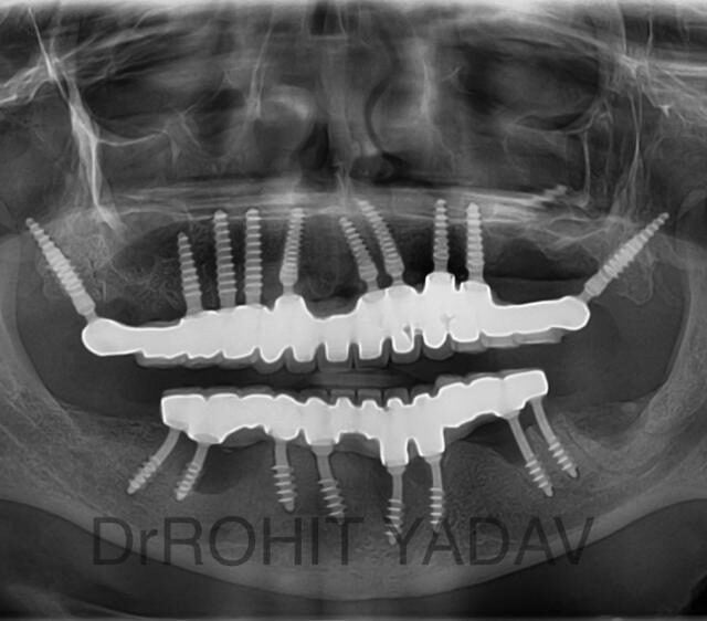 Dr. Rohit Yadav - Patient OPG - Best Implantologist in Noida (19)