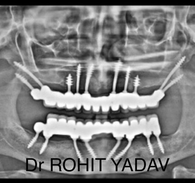 Dr. Rohit Yadav - Patient OPG - Best Implantologist in Noida (22)