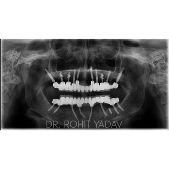 Dr. Rohit Yadav - Patient OPG - Best Implantologist in Noida (4)