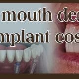 full mouth dental implant cost in Noida