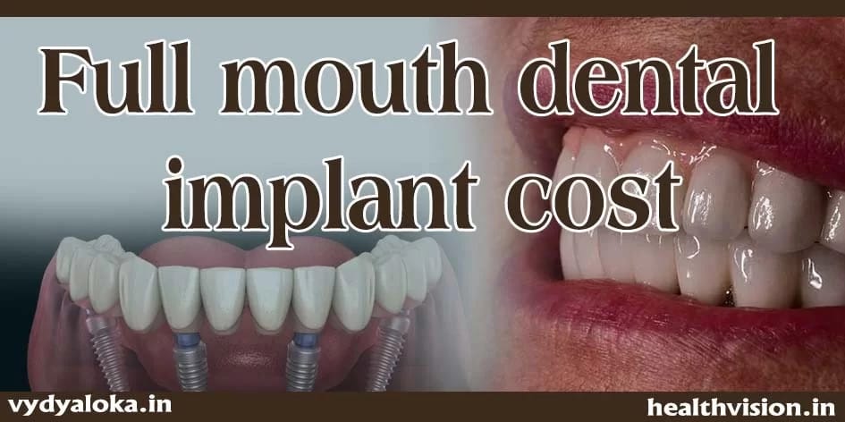 How Much Does A Full Mouth Dental Implant Cost In Noida?