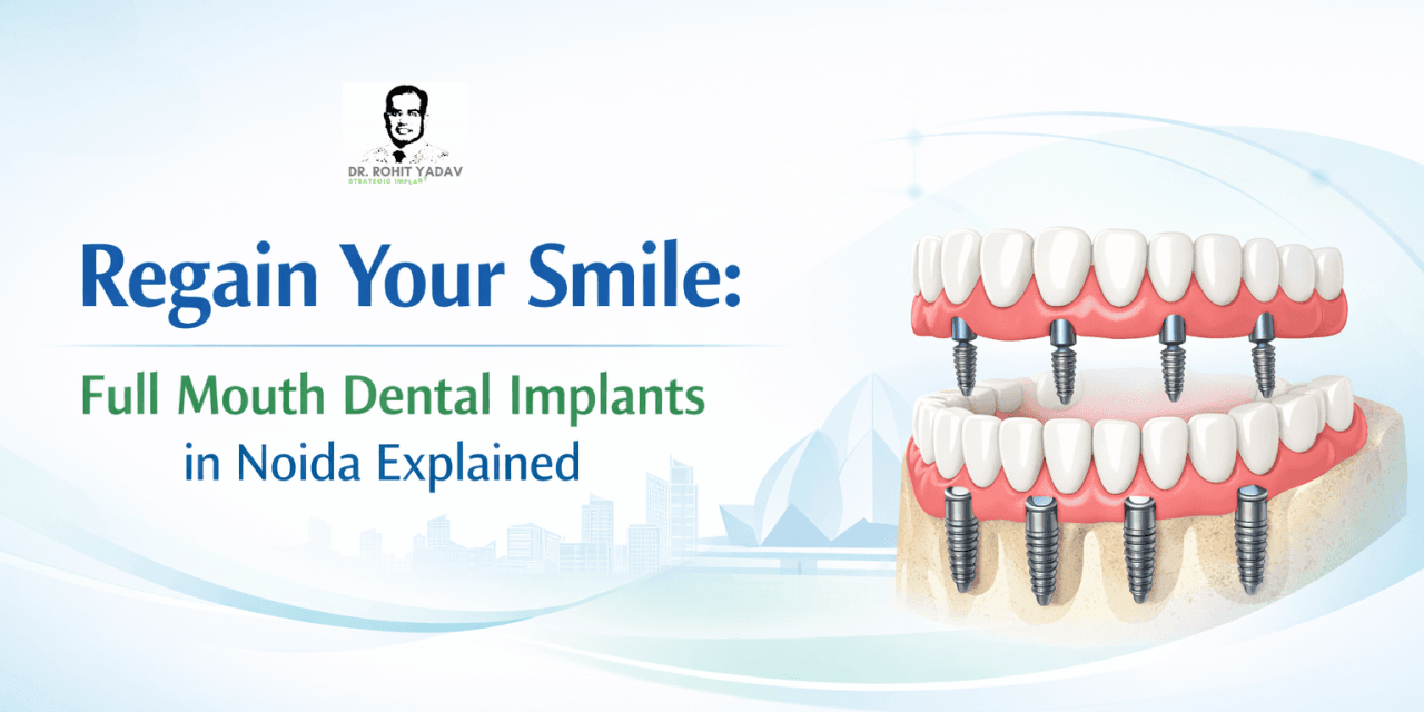 Regain Your Smile: Full Mouth Dental Implants in Noida Explained