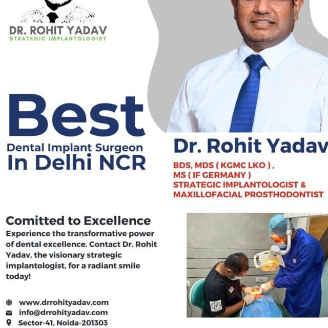 Best Dental Implants
