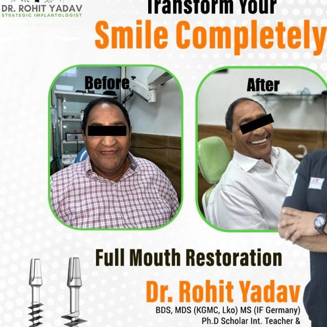 Full Mouth Restoration