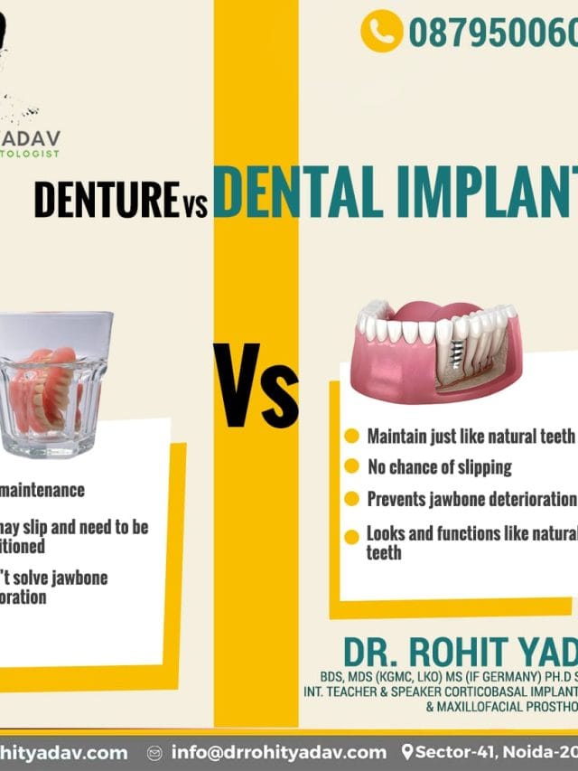 Dental Implants