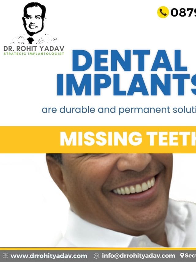 Best dental implants in India