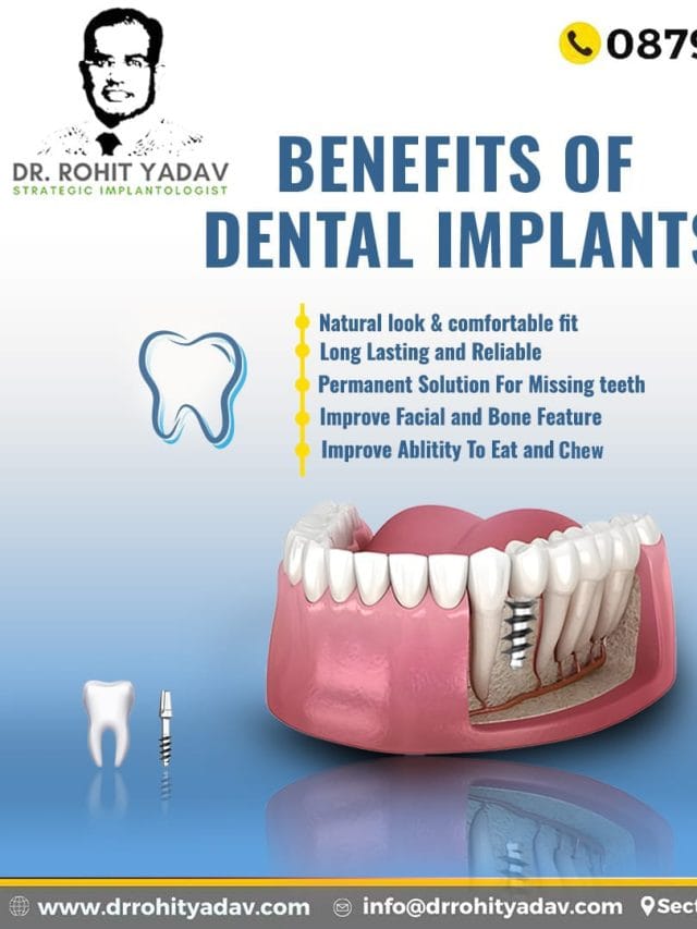 Best implant surgery in India