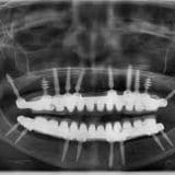Corticobasal® dental implant